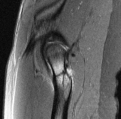 Figure 4 for case Calcar stress fracture ( RID4695 )